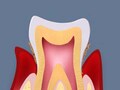 歯周病の原因・メカニズム