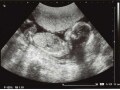 妊娠18週目 エコー写真・赤ちゃんの大きさ・胎動が分かる人も