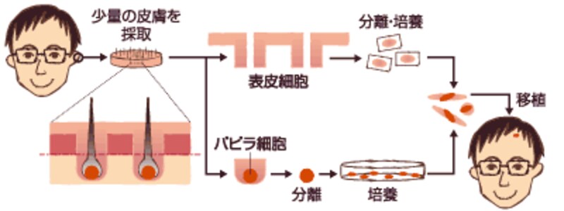 毛髪再生医療