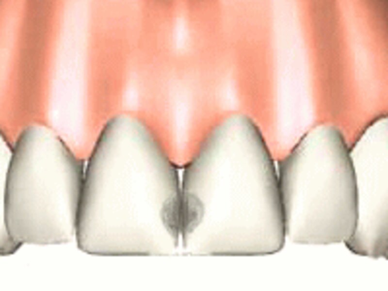 歯の詰め物の色