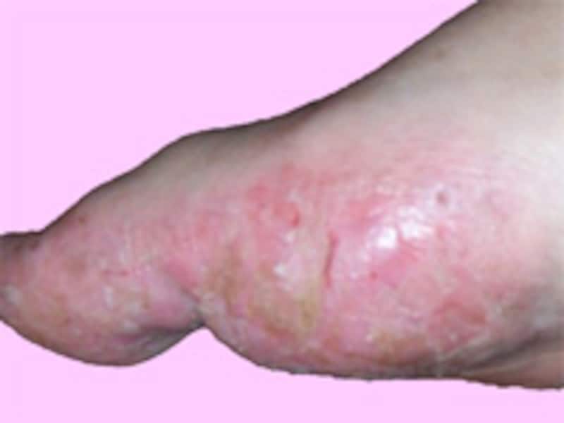 dyshidrosis_late_stage_01.jpg
