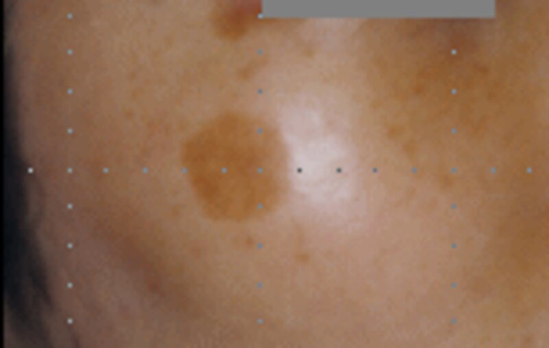 日光黒子（にっこうこくし）は別名「老人性色素斑（ろうじんせいしきそはん）」とも呼ばれます。比較的大きな褐色の色素斑で中年以降の女性に最も多く見られます。