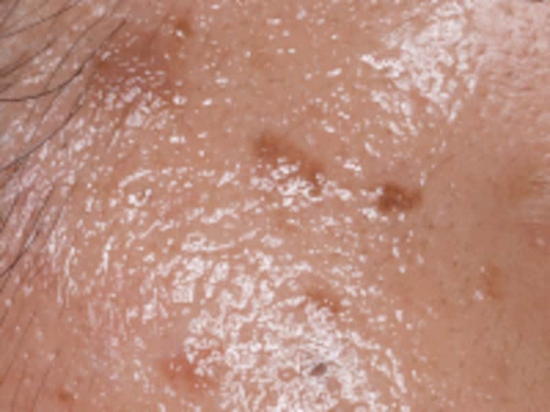 脂漏性角化症（しろうせいかくかしょう）は中年以降に発生し加齢とともに増える皮膚の良性腫瘍で、皮膚の老化現象のひとつとされています。