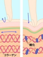 糖化が進むと肌の弾力が失われ、たるみやシワの原因になる