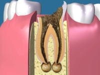 神経を取った後、数年経過後して発見されることも多い