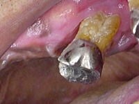 歯の根が完全に骨から見放された状態が歯周病の末期P3