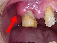 ブヨブヨした腫れと歯の周囲にたくさんのプラークが見られる