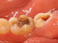 同じように歯磨きしていても、虫歯になる歯と、ならない歯は何かが違うはず