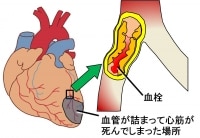 急性心筋梗塞では心臓の筋肉が死んでしまいます