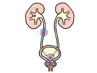 赤丸上=腎臓結石、中=尿管結石、下=膀胱結石