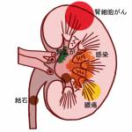 腎臓内の主な疾患