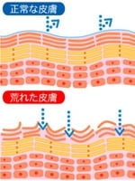 角質層の脂質や水分が奪われ、肌表面の溝(みぞ)に沿って生じた亀裂が「ひび」。この状態がさらに悪化し、肌表面にとどまらず真皮層まで深く亀裂が生じてしまったものが「あかぎれ」です