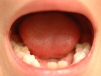 口の中に口内炎ができます。痛みで食べることができないことも。