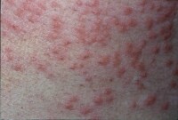 チャドクガ(毛虫)による虫さされ
