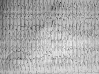 EEG