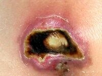 壊死した黒色の皮膚