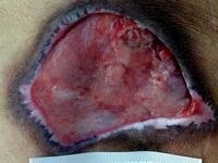 壊死した皮膚を切除した後