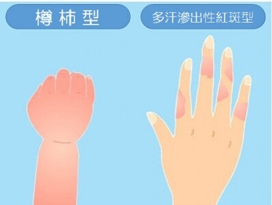 子どもに多く見られる「樽柿型」。大人にも症状の多い「多形滲出性紅斑型」