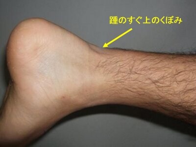 断裂したアキレス腱
