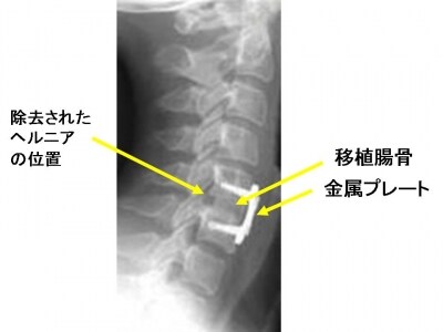 前方固定術の術後単純X線像