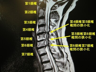 MRI