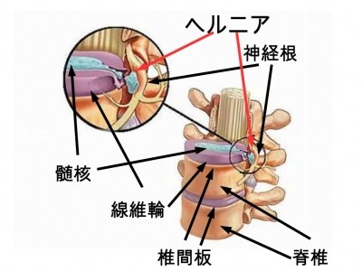 ヘルニア
