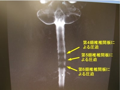 脊髄
