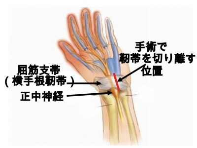 手術