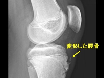 オズグウドシュラッター病