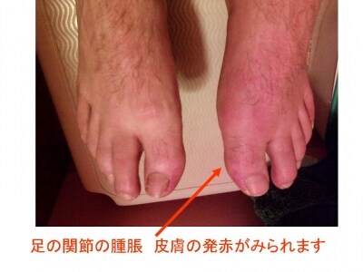痛風