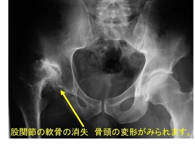 変形性股関節炎。