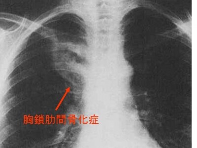 胸部X線