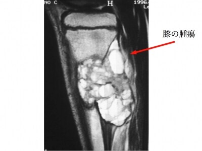 MRI