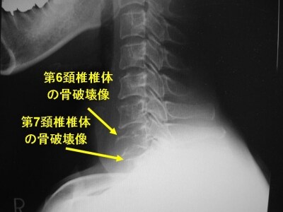 頚椎単純X線側面像