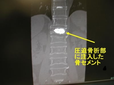 術後CT