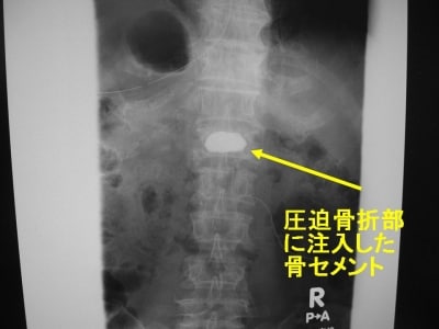 術後X線