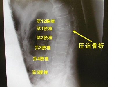 腰椎単純X線側面像