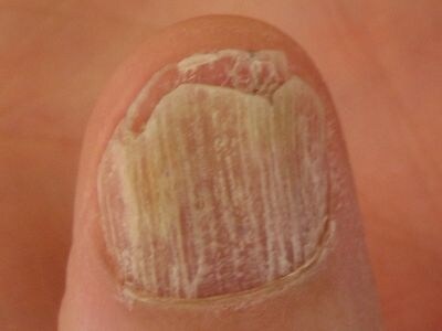 主な爪の病気一覧・症例画像 皮膚・爪・髪の病気 All About