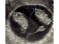 双子・多胎妊娠の仕組みと出産方法