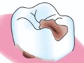虫歯vs歯周病　より痛くなるのはどっち？