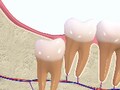 親知らずが引き起こす最悪の結果とは？