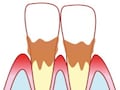 口の時限爆弾？ 「隠れ歯周病」にご用心！