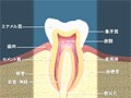 虫歯の原因・メカニズム