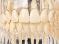 保険適用外の被せもの、「セラミック」のメリットとは