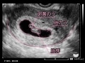 妊娠7週目 胎芽・胎嚢のエコー写真や大きさ・つわりや流産