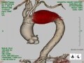 大動脈瘤（真性瘤）の治療・手術・ステントグラフ治療
