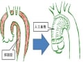 大動脈解離の治療・手術