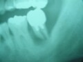 治療法は抜歯のみ!? 歯周病が手遅れになるケース