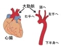 大動脈炎症候群の原因・症状・治療・予後