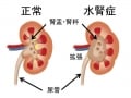 子どもの水腎症の症状・原因・治療法